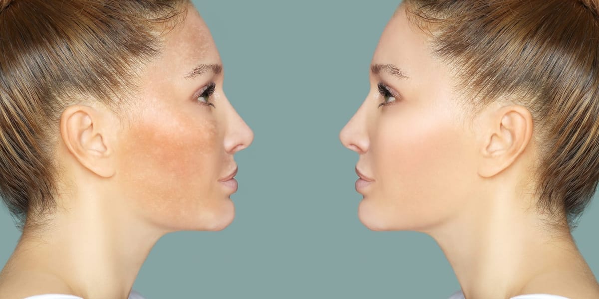 Hyperpigmentation Myths Debunked