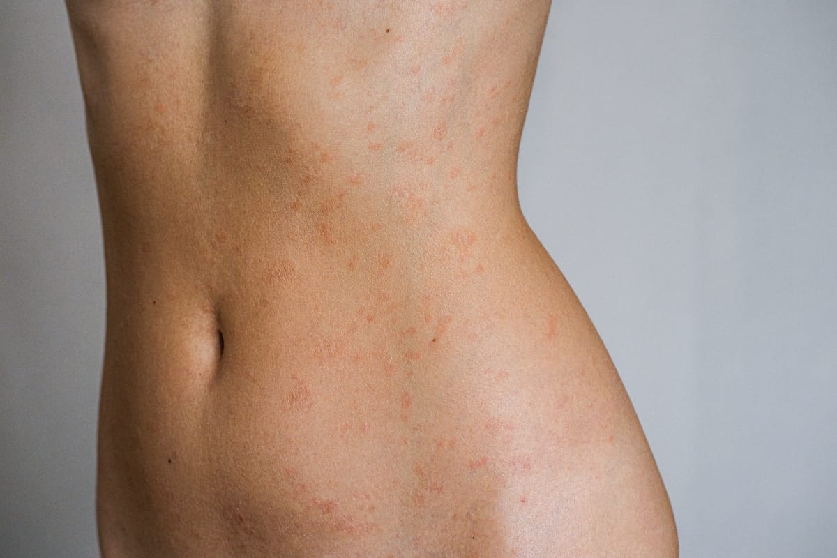 Eczema vs. Psoriasis: Key Differences