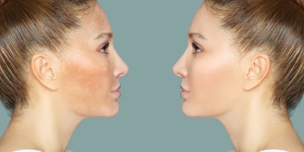 Hyperpigmentation Myths Debunked
