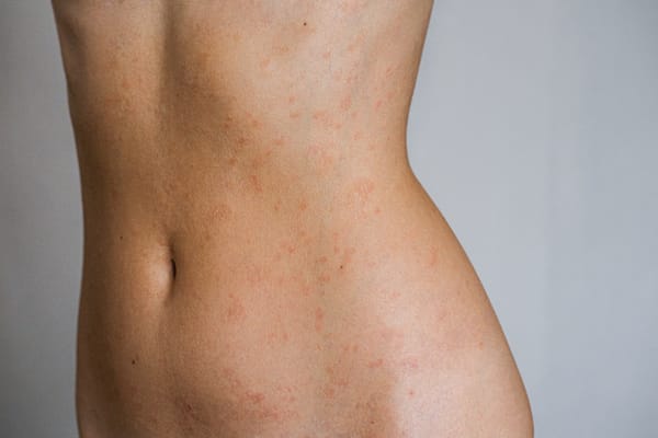 Eczema vs. Psoriasis: Key Differences